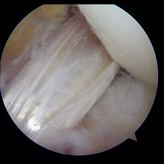 Kreuzband 3 Kreuzbandersatz