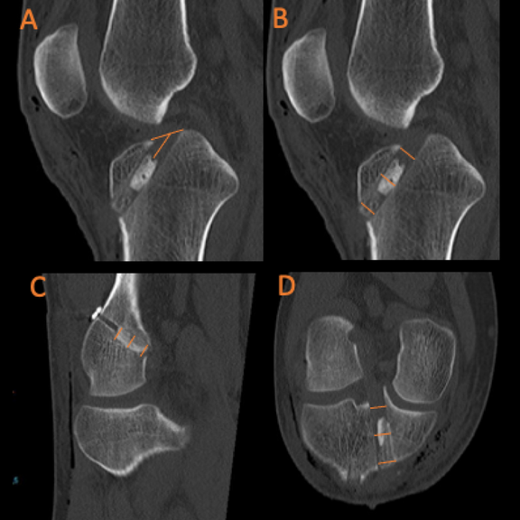 BTB BOB Technik knöcherne Einheilung Publikation Knee Journal 2023 BTB BOB Technik knöcherne Einheilung Publikation Knee Journal 2023