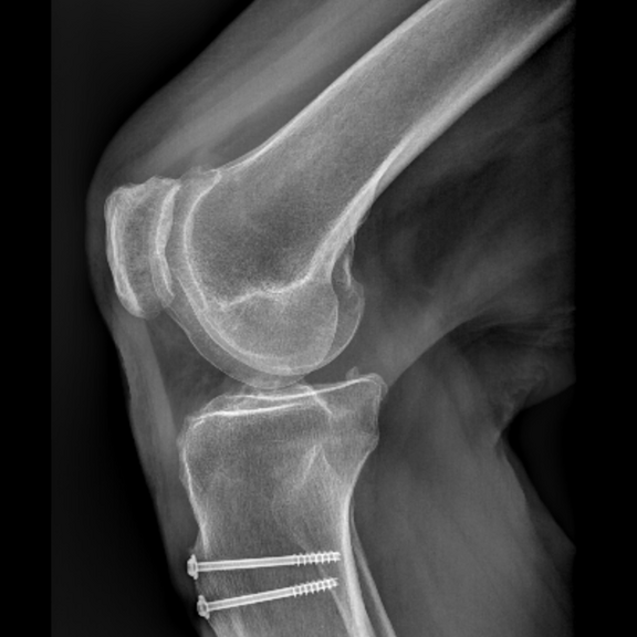 Tuberositas Osteotomie Tuberositas Osteotomie