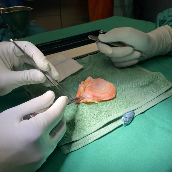 Meniskus Transplantat